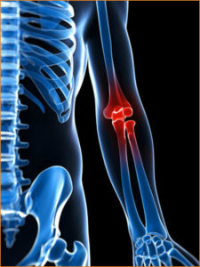 rsi kans tennisarm muisarm behandeling